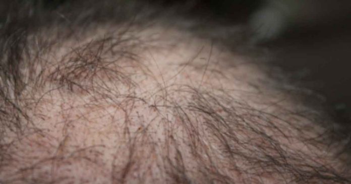 Taking Vitamin D Help Treat Hair Loss